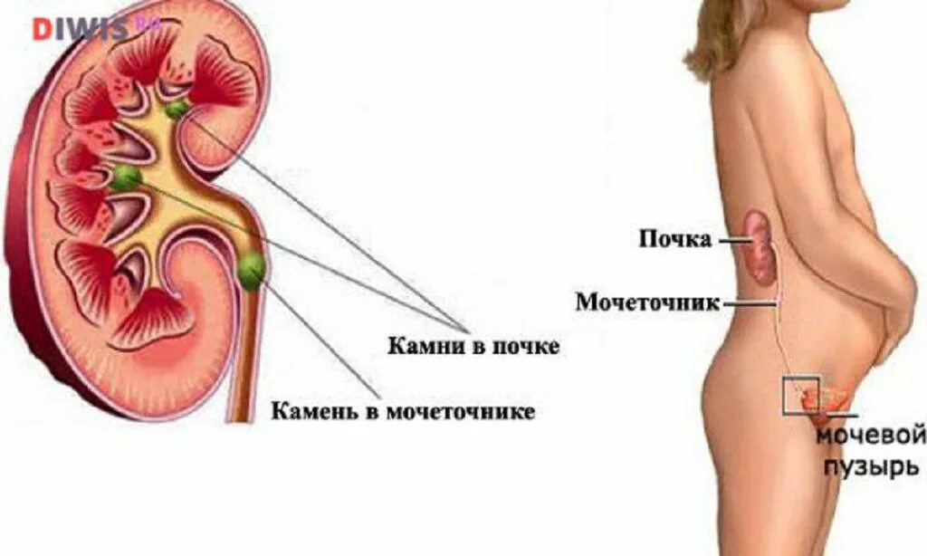 Мочеточник беременность. Почки при беременности. Камни в почках при беременности.