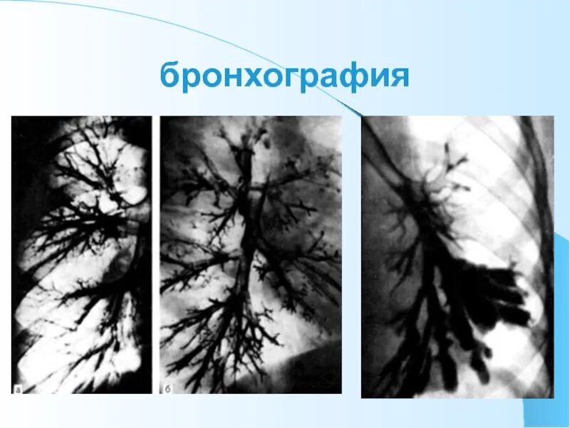 Бронхоэктатическая болезнь бронхография. Контрастная бронхография. Бронхография лучевая диагностика. Бронхография метод исследования. Детектор бронхографии.