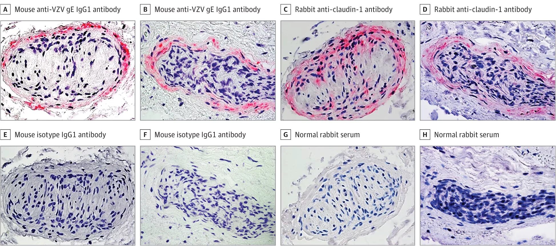 Varicella zoster virus igg. Вирус герпеса Варицелла зостер. Вирус Варицелла-зостер IGG возбудитель. Локализация вирус Варицелла-зостер.