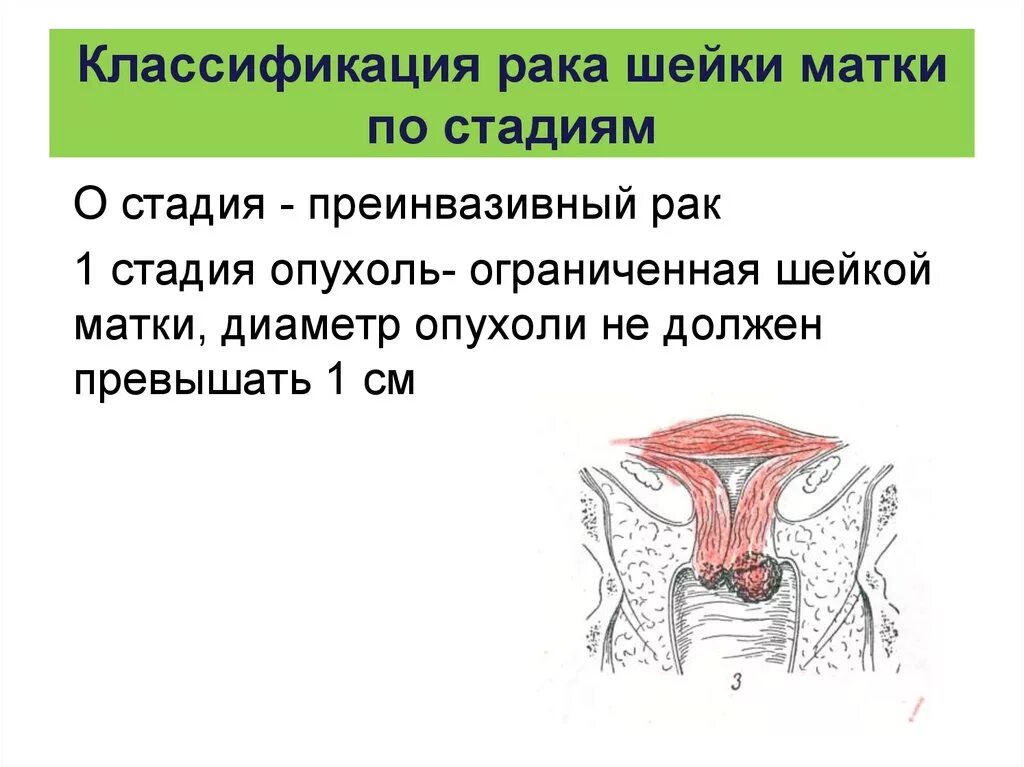 Классификация РШМ. Классификация новообразований ЖПО. Боли при раке шейки