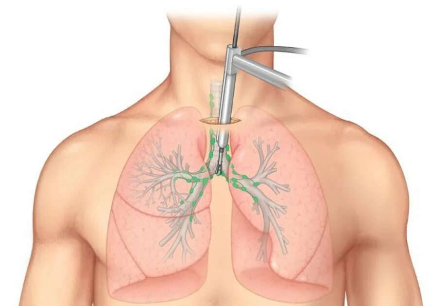 Медиастинальная пункция. Трансбронхиальная биопсия легкого. Лимфоузлы средостения биопсия. Плевральная пункция и бронхоскопия.. Через легкие удаляются