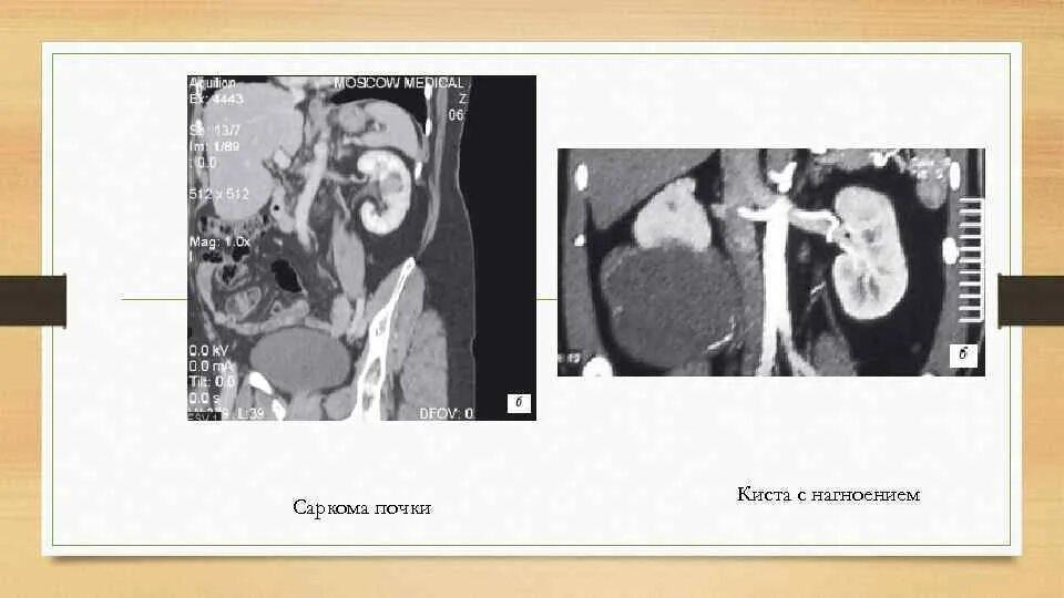 Киста в почке лечение у взрослых женщин. Киста с кровоизлиянием в почке на кт. Лучевая картина киста почки.