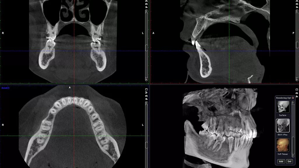 Кт челюсти (конусно-лучевая компьютерная томография). Кт 3d верхней и нижней челюсти. Кт д т