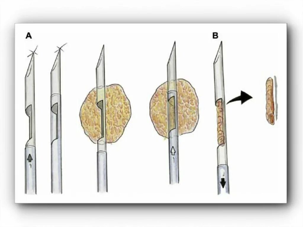 Трепанобиопсия молочной железы что это. Игла для трепан биопсии молочной железы. Инструмент для трепан биопсии молочной железы. Трепан биопсия молочной железы. Тонкоигольная аспирационная пункционная биопсия.