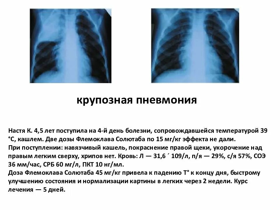 Пневмония признаки у взрослых. Пневмония симптомы. Пневмония симптомы у взрослых. Симптомы пневмонии без температуры. Пневмония симптомы у взрослых без температуры но с кашлем.