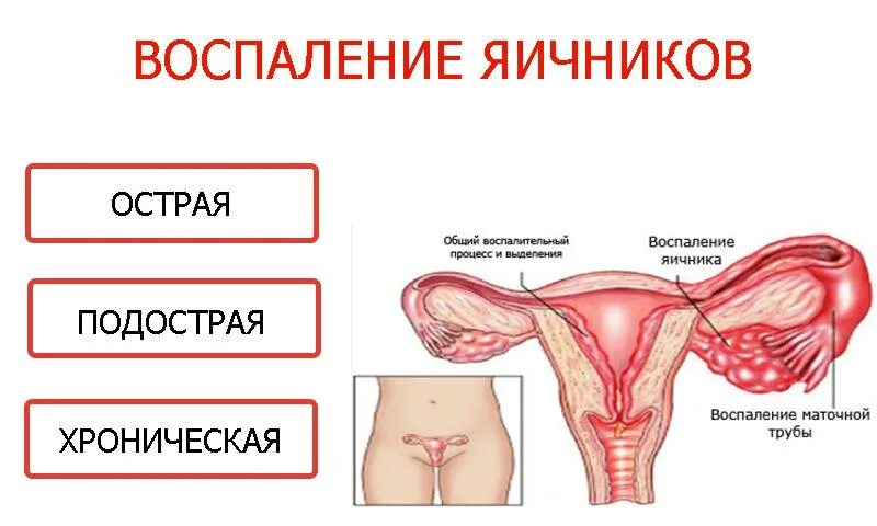 Левый придаток у женщины. Придатки у женщин воспаление. Болит правая сторона яичников