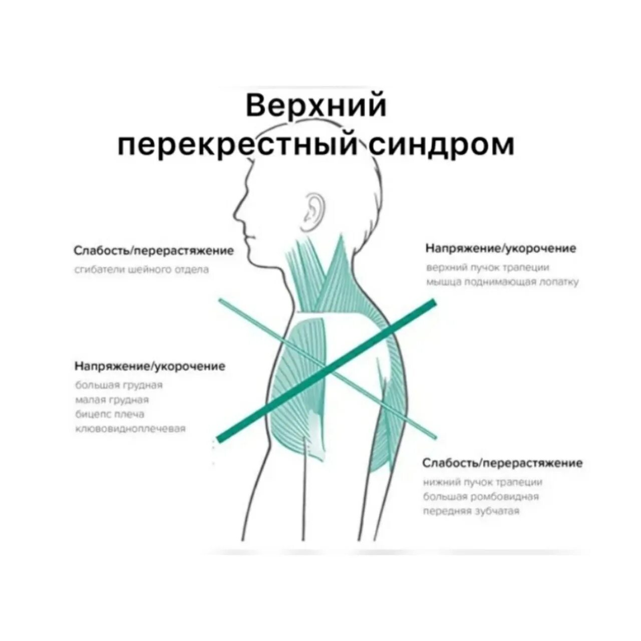 Дисбаланс как исправить. Верхний перекрестный синдром мышечного дисбаланса. верхний перекрестный синдром мышц. нижний перекрестный синдром. упражнения при верхнем перекрестном синдроме.