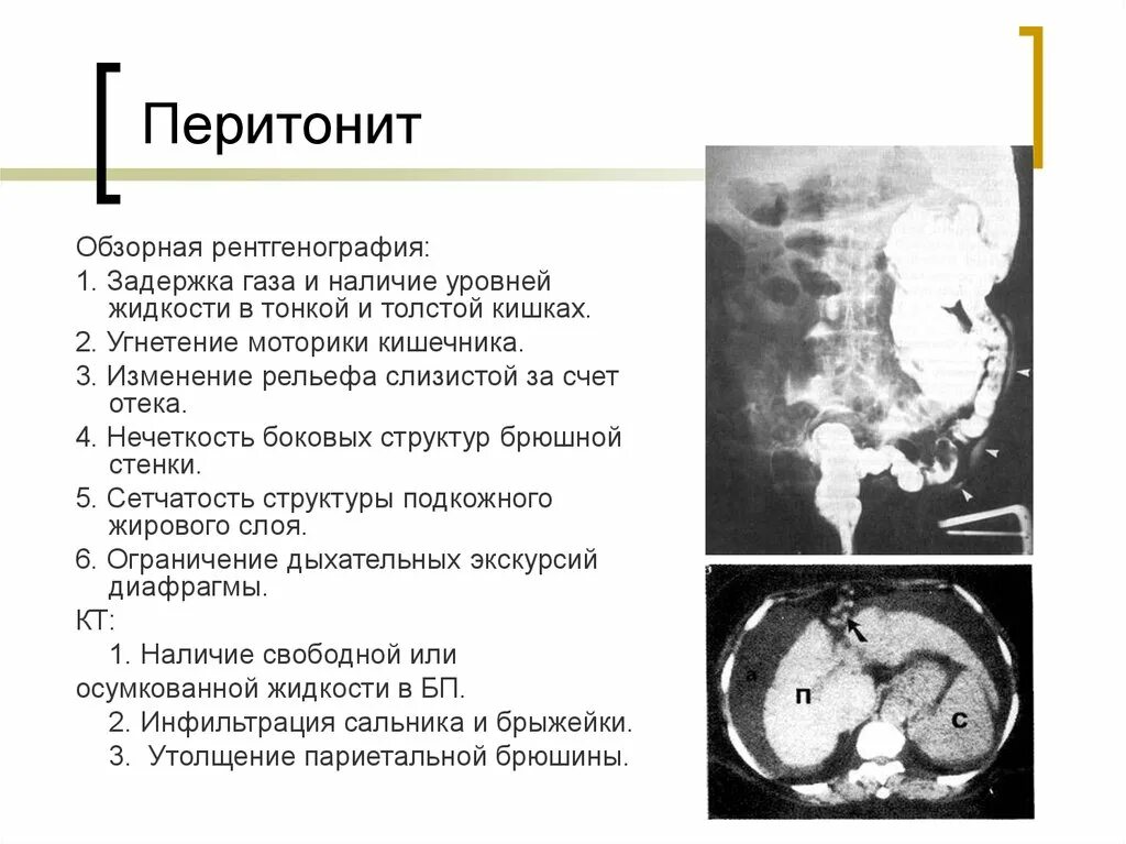 Перитонит диагностика. Перитонит синдром острого живота. Перитонит на рентгене брюшной полости.