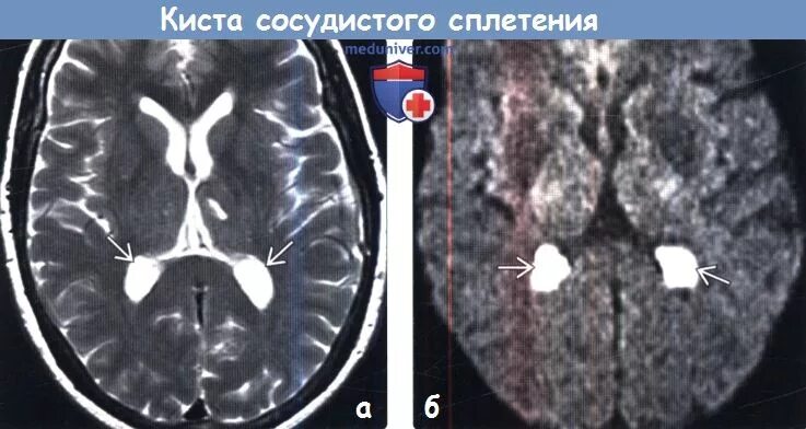 Ксантогранулёма сосудистого сплетения кт. Киста сосудистого сплетения кт. Кисты сосудистых сплетений задних Рогов боковых желудочков. Арахноидальная киста нейросонография.