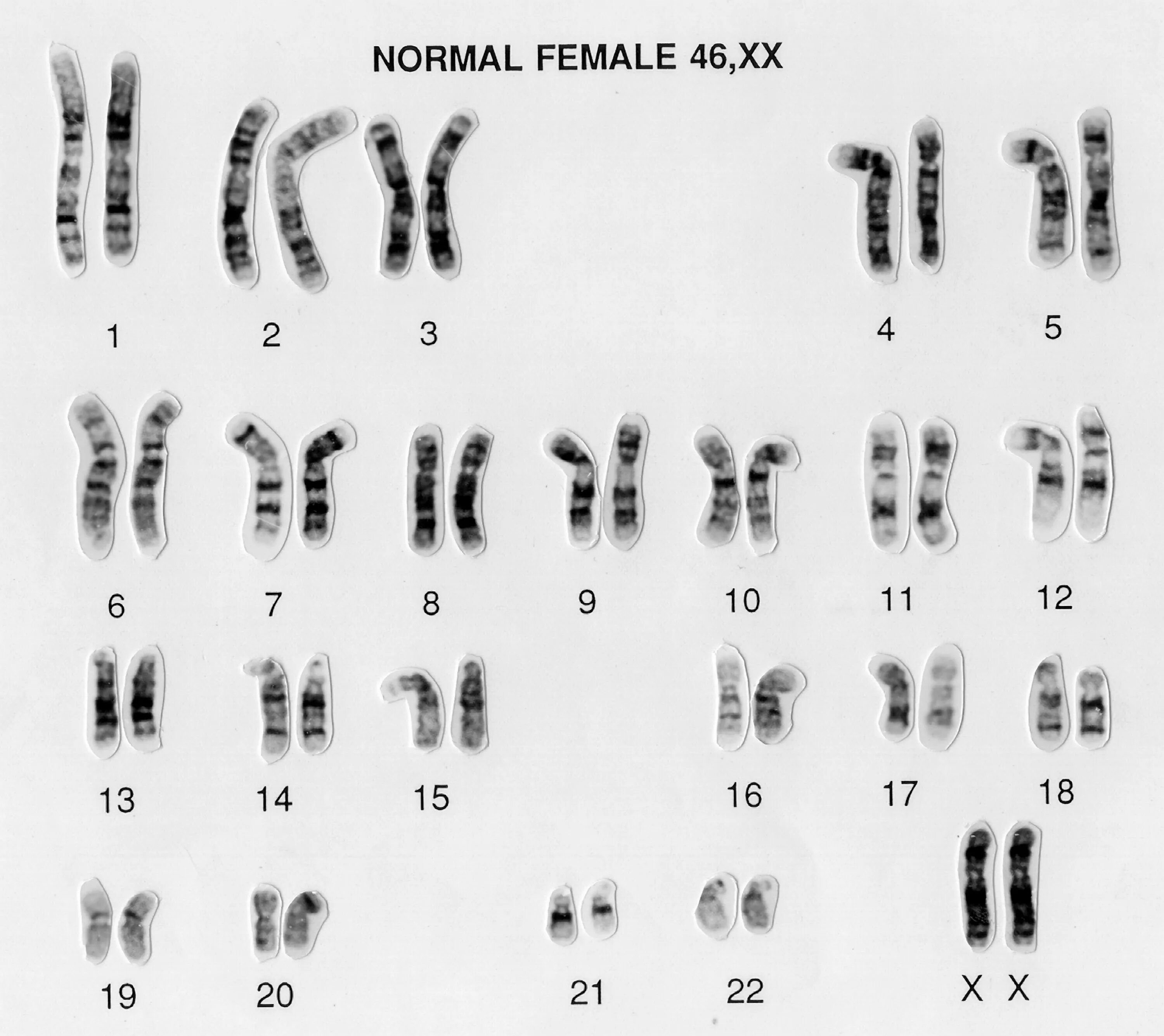 Появление дополнительной хромосомы. Нормальный кариотип женщины 46 ХХ. Кариотип 46 XX У женщин что это. Кариограмма хромосом мужчины. Кариотип 46 ХХ.