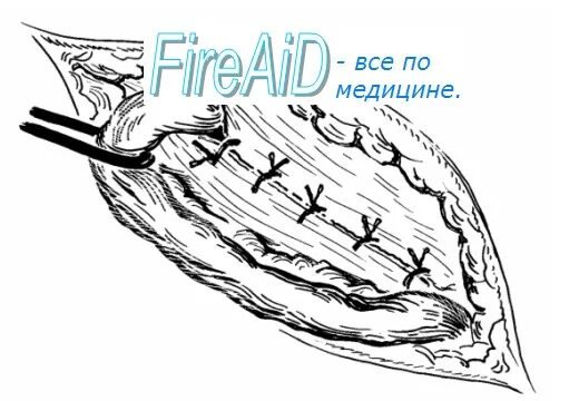 Пластика по постемпскому. Пластика пахового канала по постемпски. Пластика по постемпскому при паховой грыже. Постемпскому грыжесечение. Пластика по постемпскому.