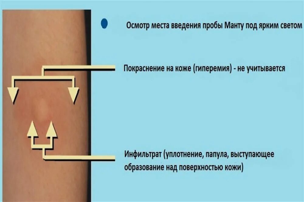 Как правильно прививка манту. Туберкулинодиагностика (проба манту с 2 те). Реакция диаскинтест норма у детей. Туберкулиновая проба реакция манту. Реакция манту у ребенка оценка реакции.