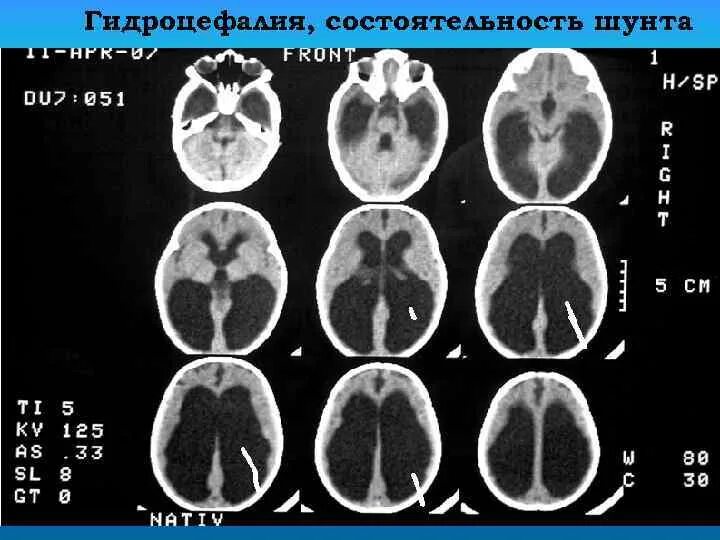 Шунт головного мозга. Степени гидроцефалии на кт. Наружная гидроцефалия на кт.