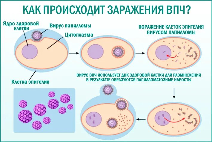 Вирус папилломы пути передачи. Папиллома человека пути передачи. Папилломавирусные инфекции пути передачи.