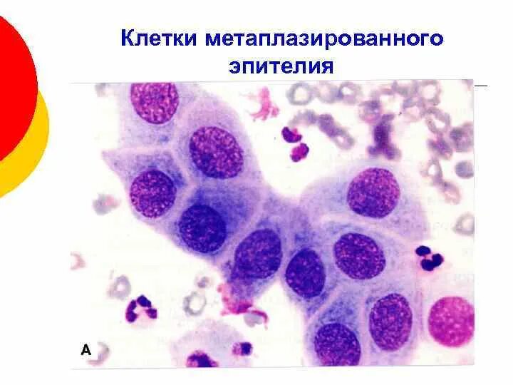 Реактивные изменения метаплазированных клеток. Плоскоклеточная метаплазия цитология. Метаплазированный эпителий цитология. Метаплазированный эпителий цитограмма. Цилиндрический эпителий цитология.