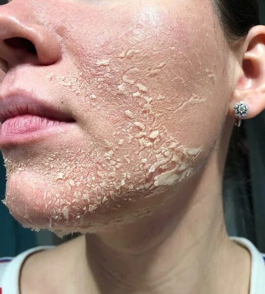 Лицо после кислотных пилингов шелушение. Салициловый пилинг для лица. Желтый пилинг шелушение. Химический пилинг джесснера шелушение. Пилинг для лица.