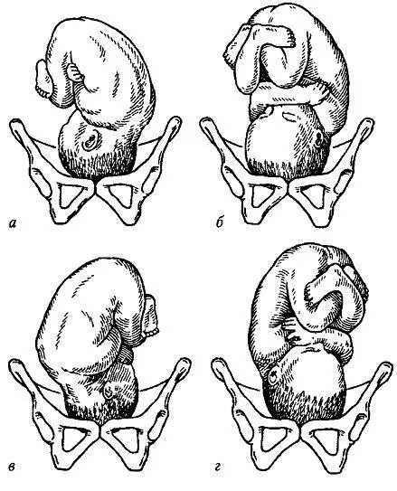 Б п родов. Головное предлежание плода 2 позиция передний вид. Затылочное предлежание передний вид 2 позиция. Головное предлежание плода 1 позиция передний вид. Положение плода продольное головное 1 позиция передний вид.