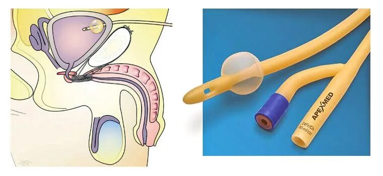 Трубочку в мочевой пузырь. Цистостома мочевого пузыря катетер. Эпицистостома катетер Фолея. Цистостома катетер Фолея. Катетер Фолея пузырь.