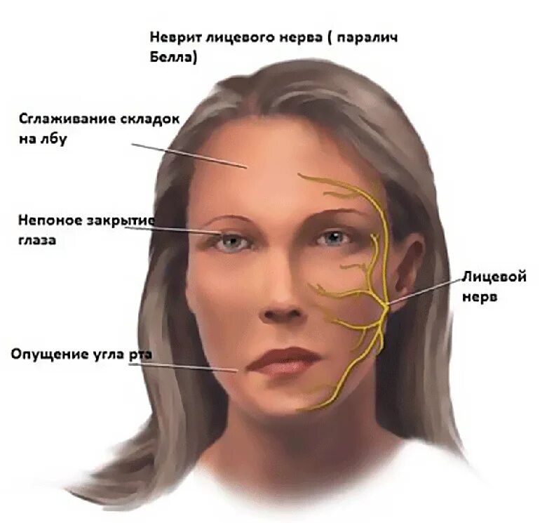 Онемевает правая сторона лица. Массаж при параличе лицевого нерва. Неврит левого лицевого нерва. Невропатия лицевого нерва парез мимической мускулатуры.