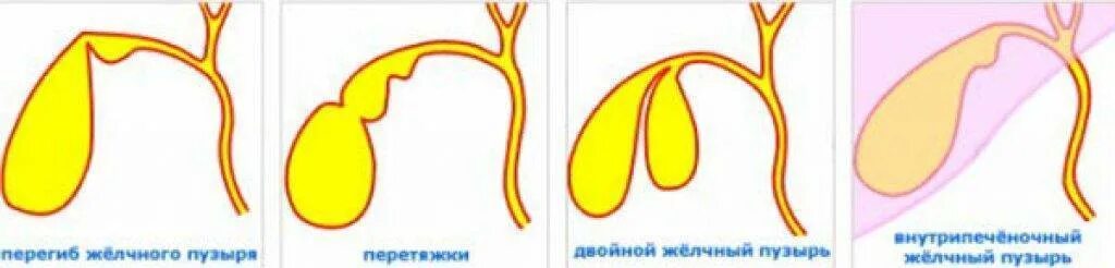 Желчный изгиб у ребенка