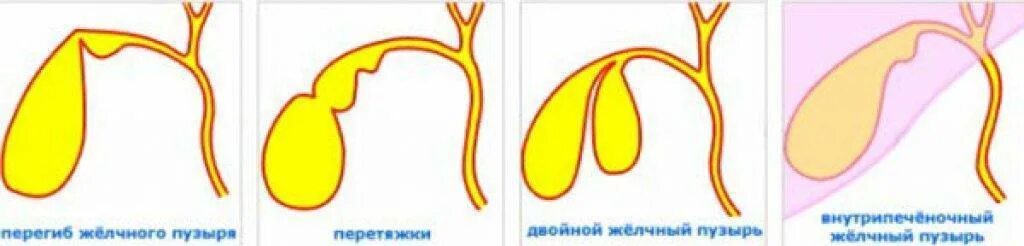 Изогнутая форма желчного пузыря. S образный Перегиб желчного пузыря. Аномалия формы желчного пузыря Перегиб. Врожденная патология желчного пузыря. Изгиб шейки желчного