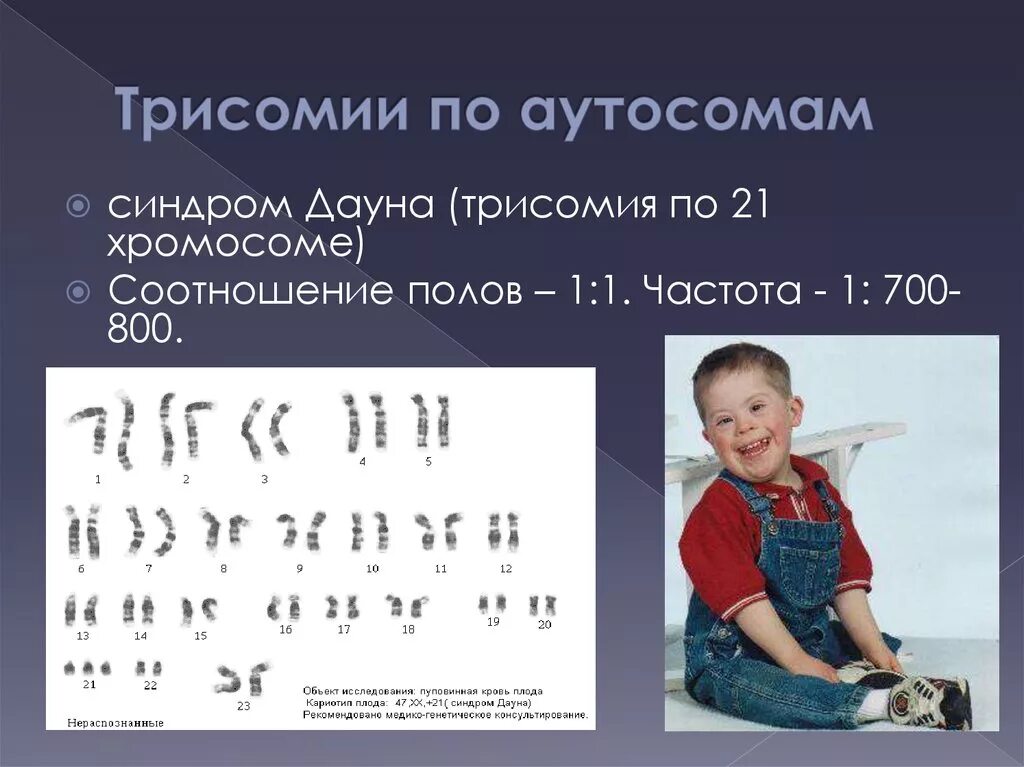 Сколько хромосом у людей с синдромом дауна. Синдром Дауна трисомия по 21 хромосоме. Трисомия х хромосомы 21. Трисомия по 21 хромосоме нерасхождение. Синдром Дауна трисомия 21 хромосомы.