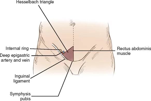 Болит паховая область у мужчин. Паховый треугольник Гессельбаха. Паховый треугольник топографическая. Паховый треугольник топографическая анатомия. Паховый промежуток анатомия.