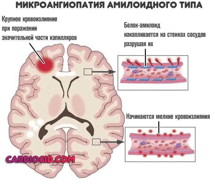 Микроангиопатия головного мозга что это. Церебральная микроангиопатия мрт. микроангиопатия лобной доли. церебральная амилоидная ангиопатия. микроангиопатия головного мозга что это такое.