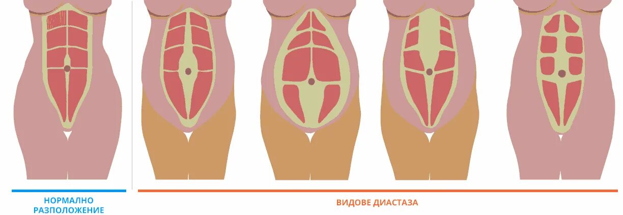 Прямая мышца живота у женщин. Диастаз мышц живота 2 степени. Диастаз мышц живота 1 степени. Степени диастаза прямых мышц живота. Диастаз белой линии живота.