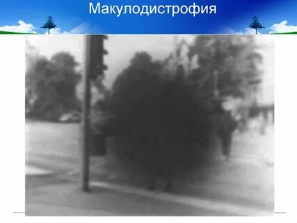 Пятна в поле зрения
