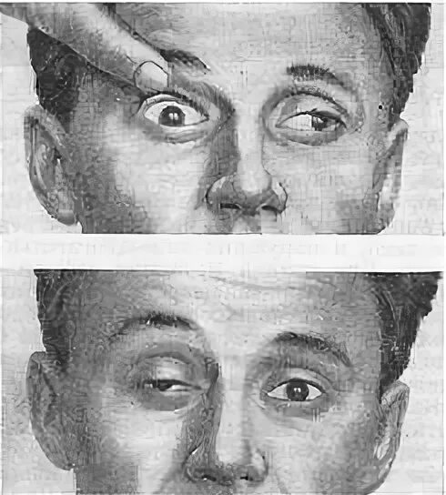 надъядерная офтальмоплегия. диплопия классификация. надъядерная офтальмоплегия. гиперсомническая офтальмоплегия. гиперсомническая офтальмоплегия.