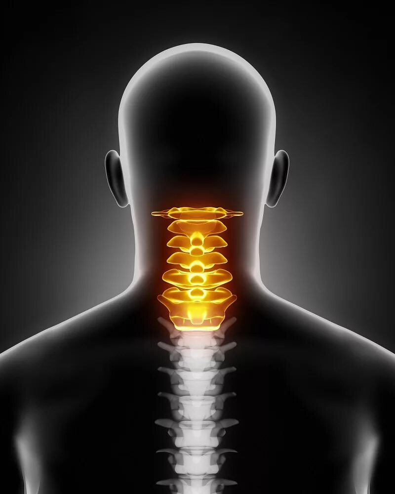 Хондроз шейного отдела позвоночника. Протрузия шейного отдела позвоночника. 7 Шейный остеохондроз. Позвоночник шея.