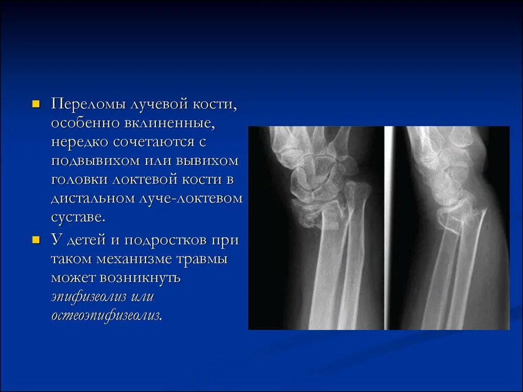 Диагноз перелома лучевой кости. Перелом метаэпифиза лучевой кости. Перелом Нижнего конца лучевой кости рентген. Перелом головки лучевой кости со смещением рентген. Вывих дистального отдела локтевой кости.