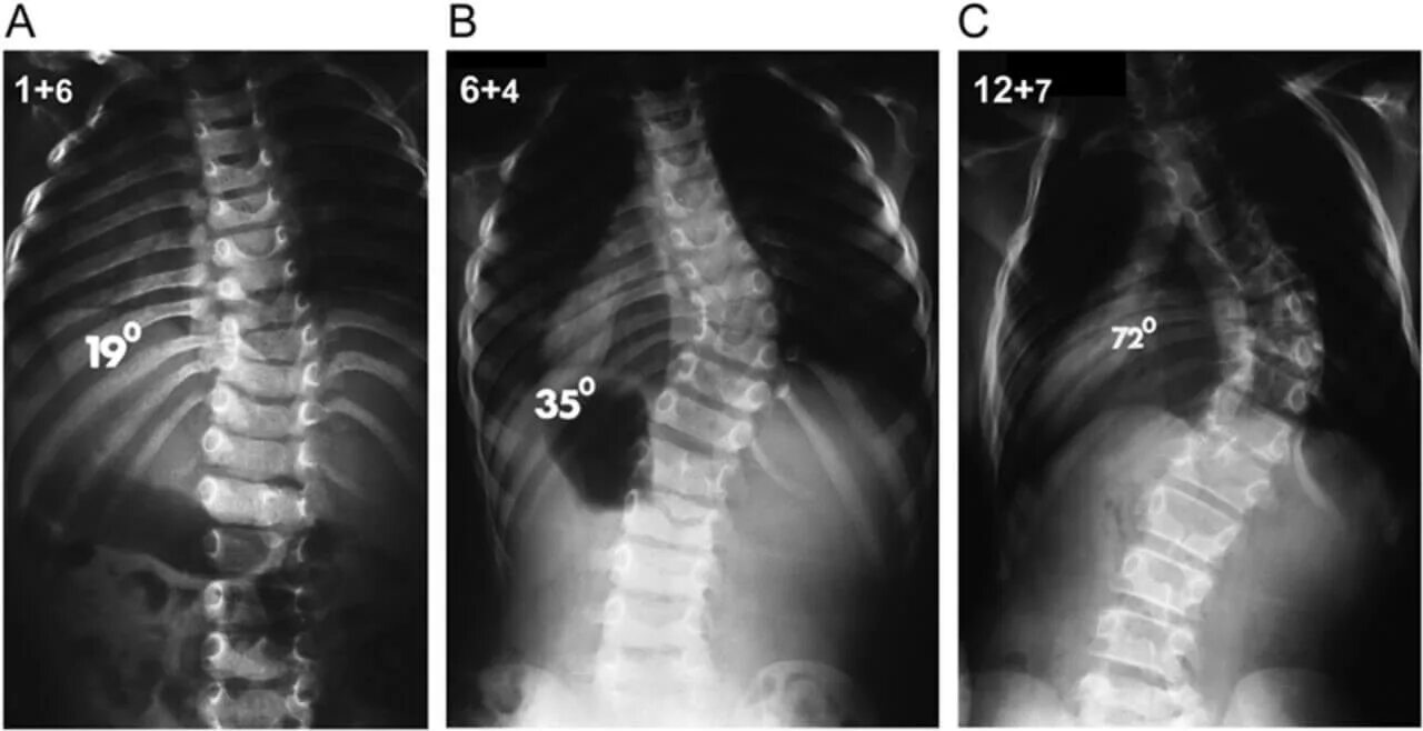 Искривление позвоночника градусы. Сколиоз 2 степени снимок рентген. Сколиоз поясничного отдела 2 степени рентген. Сколиоз поясничного отдела рентген. Сколиоз позвоночника рентген степени.