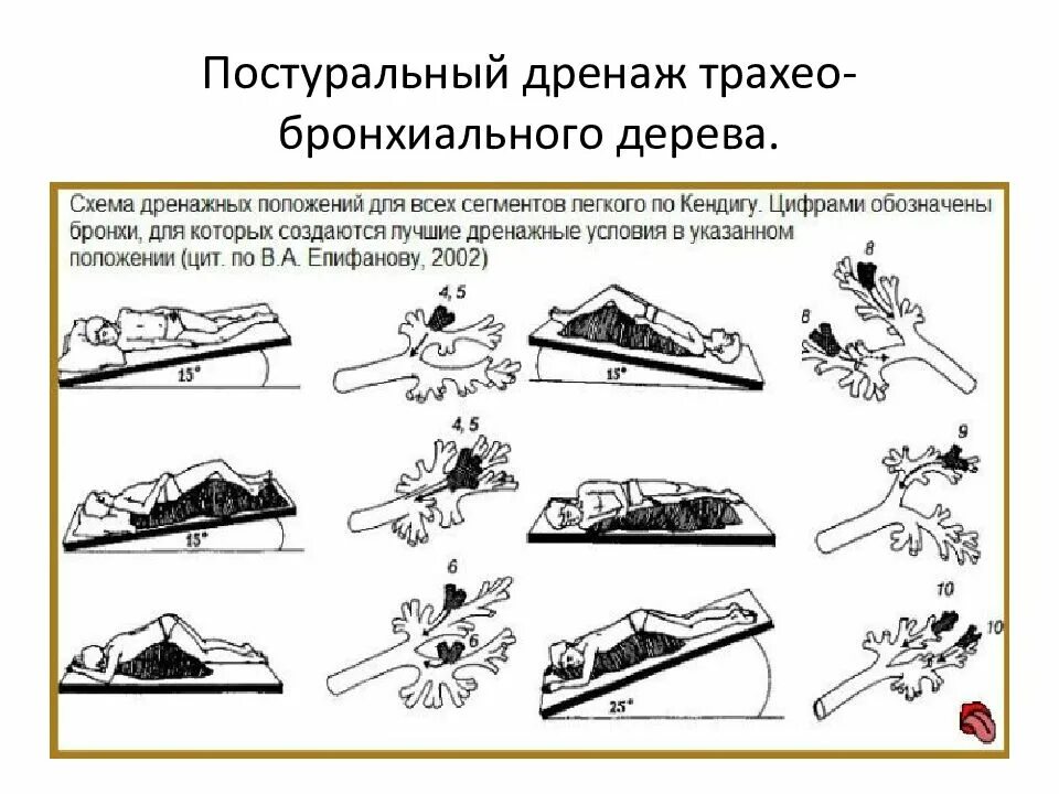 Дренажные положения для отхождения мокроты. Дренажное положение при бронхите. Методика постурального дренажа бронхов. Методика проведения постурального дренажа алгоритм. Постуральный массаж