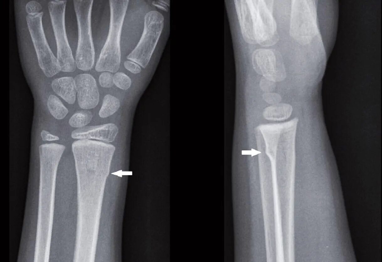 Radius fracture