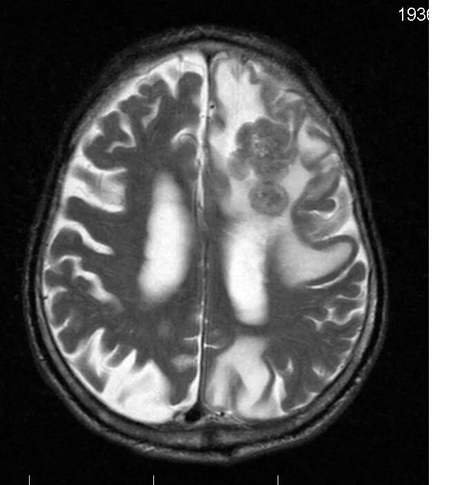 Туберкулез головного. Туберкулез головного мозга кт. Туберкулема головного мозга мрт. Туберкулемы головной мозг мрт.