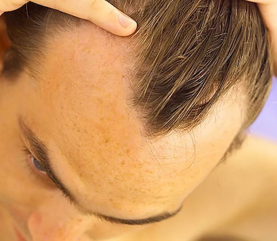 Выпадение волос у мужчин лечение. Андрогенная алопеция Гамильтон. Лобное облысение у мужчин.