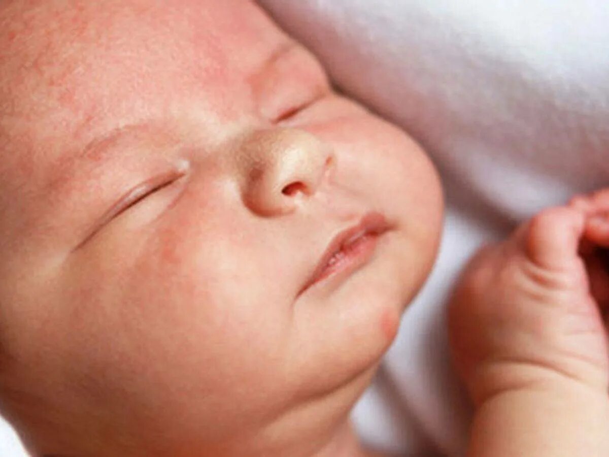 Atopic Dermatitis Symptoms in Children Are Persistent