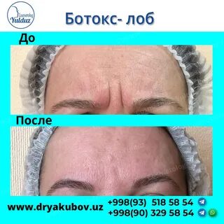 Диспорт в лоб отзывы