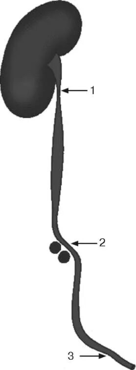 3 части мочеточника. Мочеточники части сужения. Сужения мочеточника анатомия. Строение мочеточника сужения. Изгибы и сужения мочеточника.