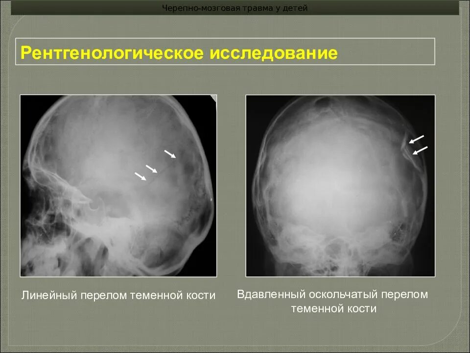 Травма в мозгу повреждения. Передом стременной кости. Вдавленный перелом теменной кости. Линейный перелом теменной кости у ребенка. Черепно-мозговая травма.