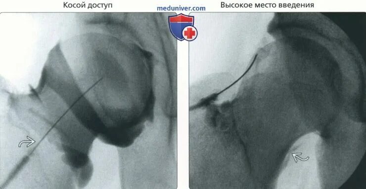 Https meduniver com medical book. Контрастная артрография тазобедренного сустава применяется. Кт артрография коленного сустава. Артрография показания.