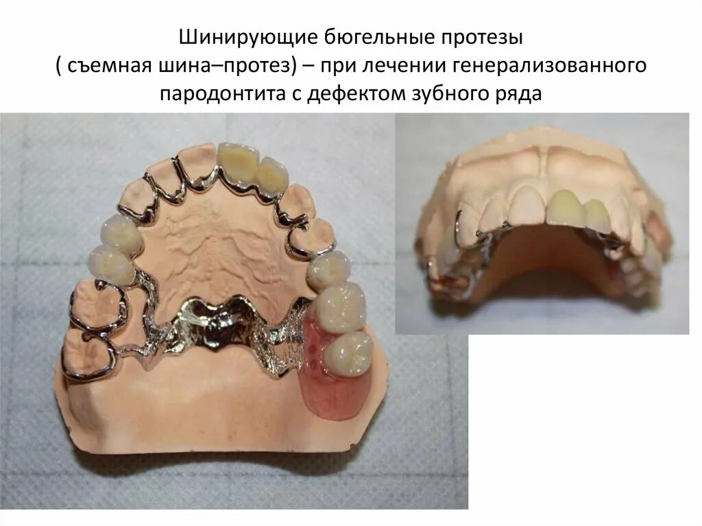 Многозвеньевой бюгельный протез. Шинирование бюгельный протез. Шинирующие элементы бюгельного протеза. Бюгельный протез многозвеньевой шинирующий. Бюгельный протез дефекты