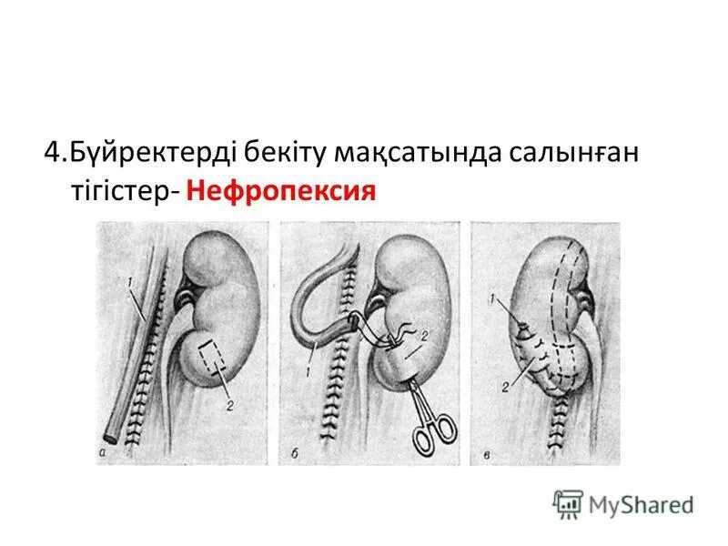 Операции при нефроптозе( нефропексия). Операция нефропексии. Нефроптоз почки операция. Нефропексия пытеля лопаткина. Операции при нефроптозе( нефропексия).