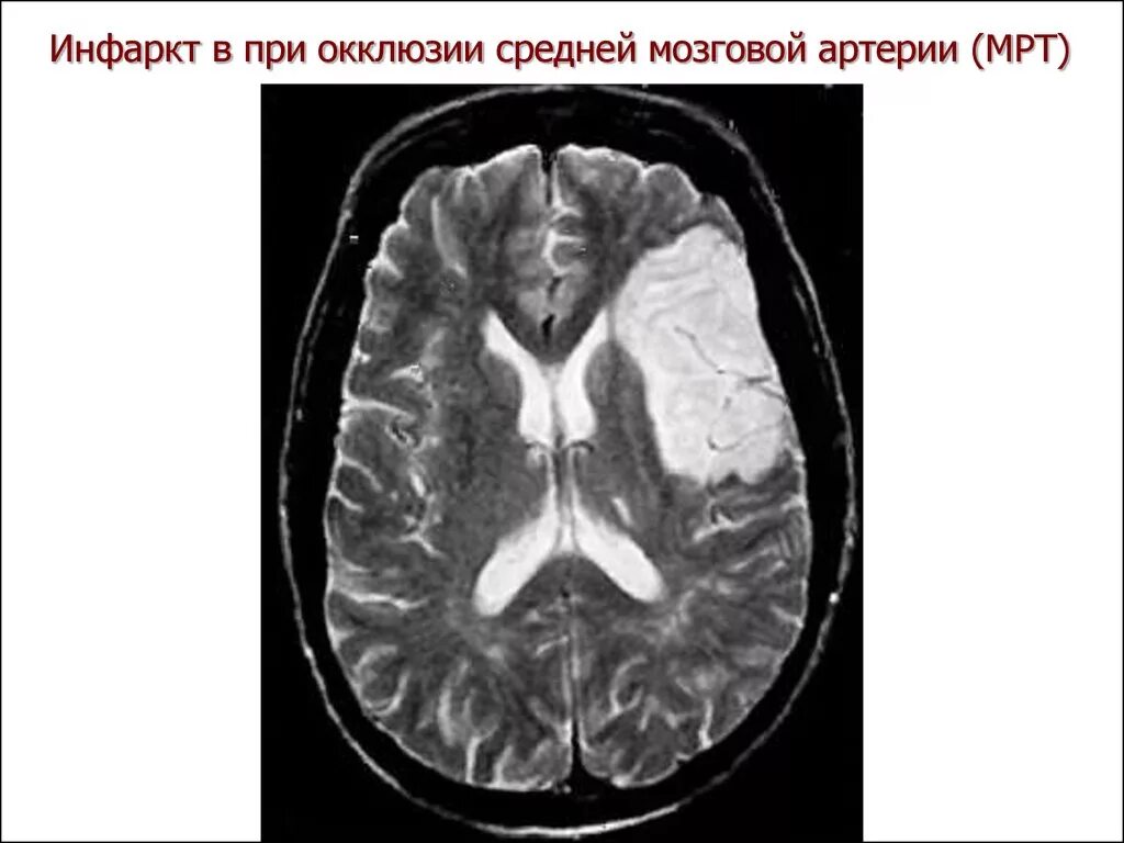 Инсульт правого бассейна. Мрт при инсульте в бассейне средней мозговой артерии. Инфаркт в бассейне левой средней мозговой артерии. Инфаркт головного мозга в бассейне правой средней мозговой артерии. Ишемический инфаркт передней мозговой артерии на кт.