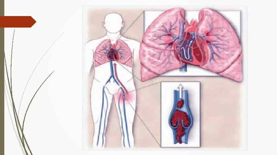 Тромбоэмболия легочной артерии. Эмболия тромбом легочной артерии. Тромбофлебит легочной артерии