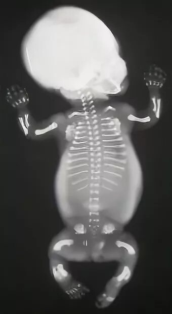 Кистозная дисплазия и мультикистоз почки. Дисплазия плода. Кистозная дисплазия почек узи. Дисплазия плода. Симптом тюльпана у плода на узи.