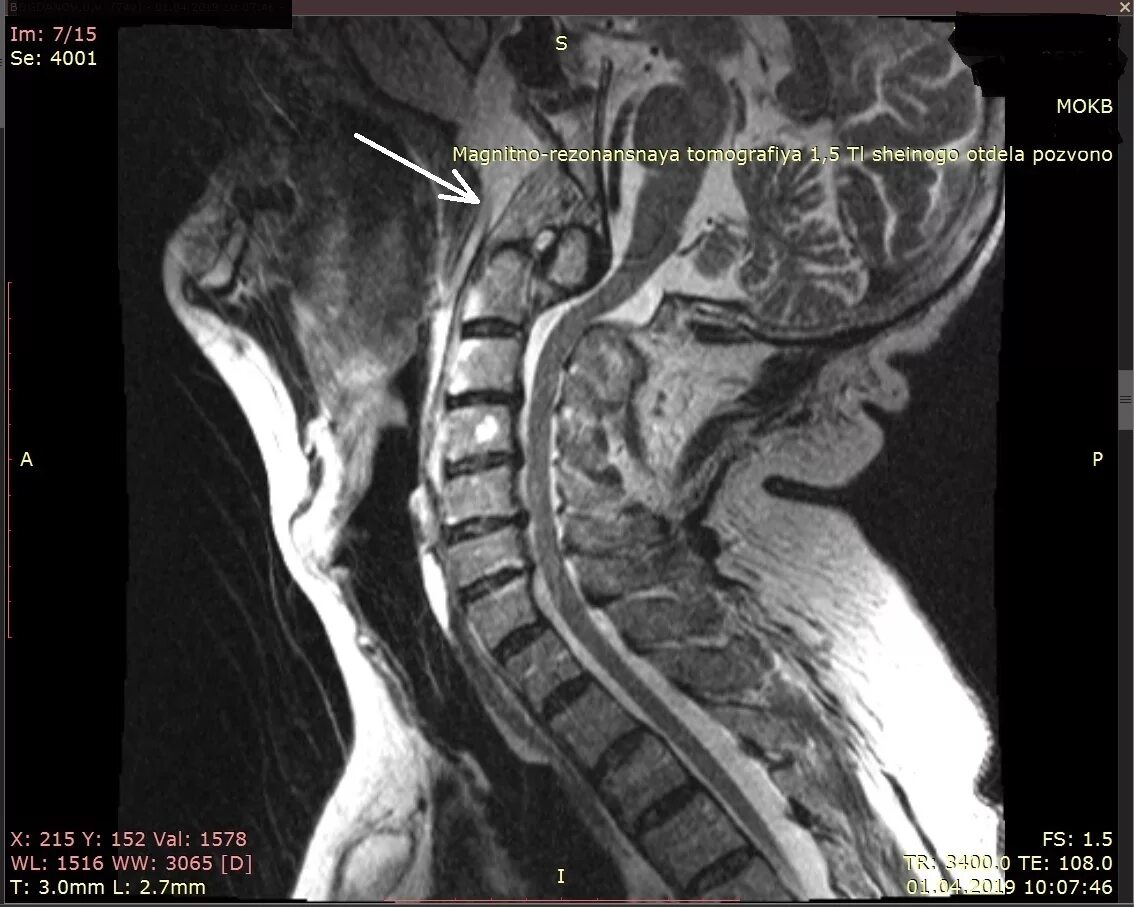 Операция грыжи шейного отдела позвоночника отзывы. Смещение позвонков шейного отдела мрт. Мрт шейного отдела смещение позвонка. Грыжа шейного отдела позвоночника мрт. Перелом 5-6 шейного позвонка.