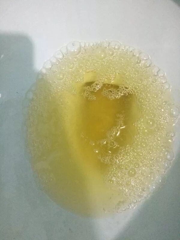 Моча сильно пенится. Желтая прозрачная жидкость. Пузырьки в моче.
